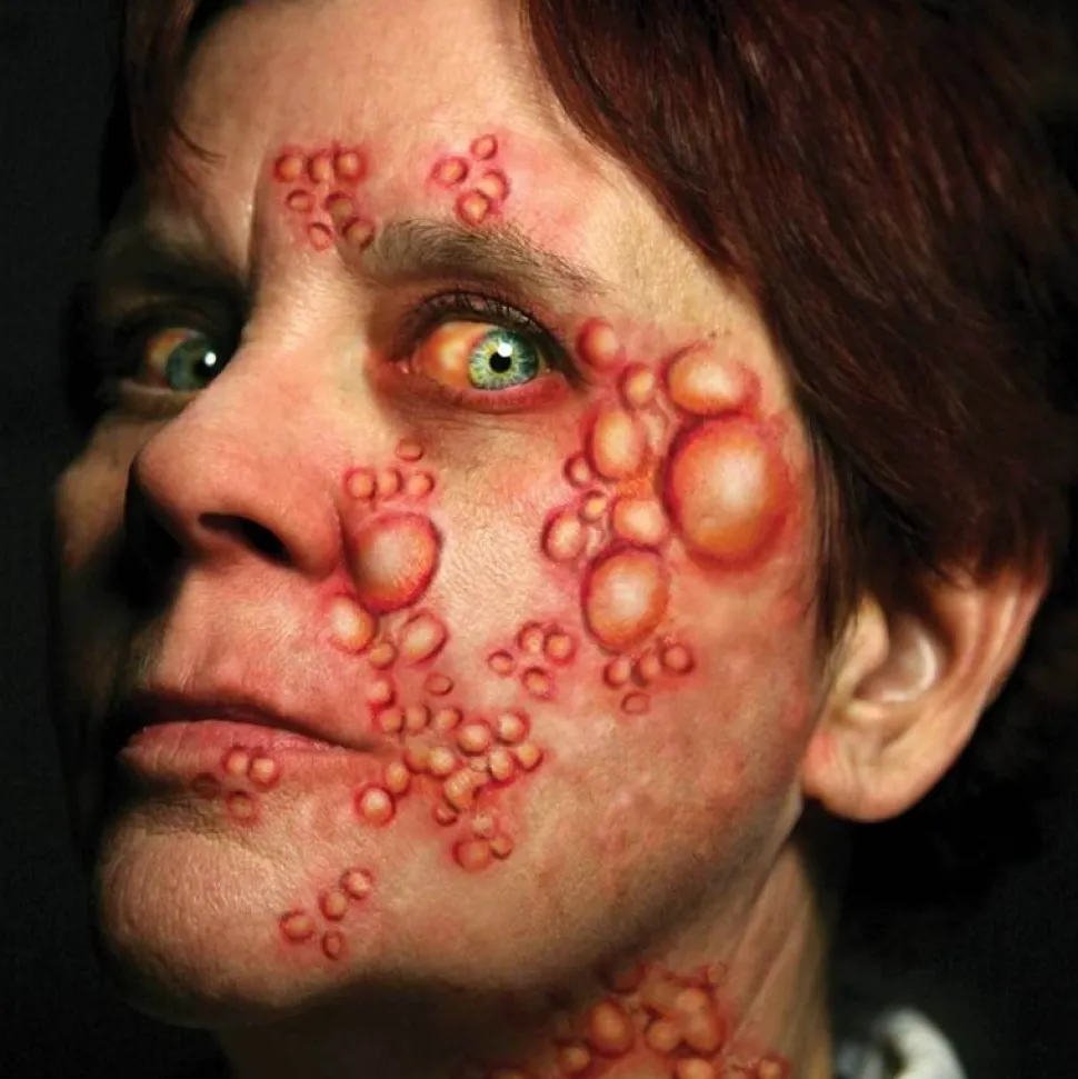 Tatovering, Diseased